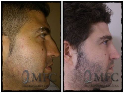 Rinoplastia